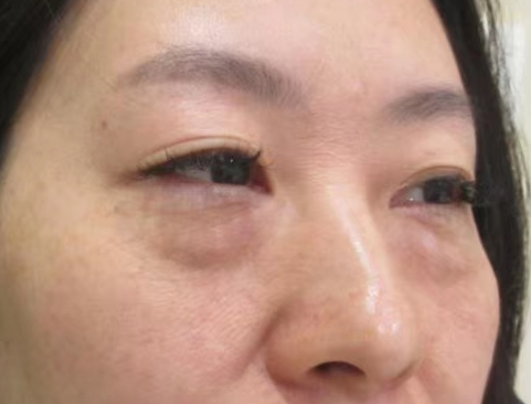 去眼袋手术
