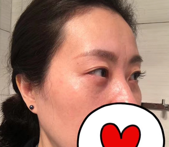 去眼袋手术