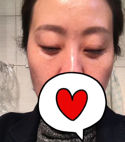 去眼袋手术