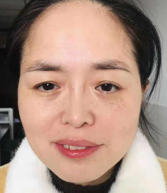 去眼袋手术