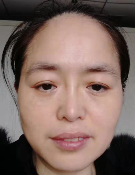 去眼袋手术