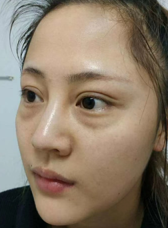 去眼袋手术
