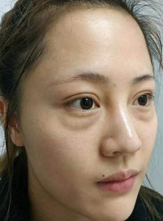 去眼袋手术
