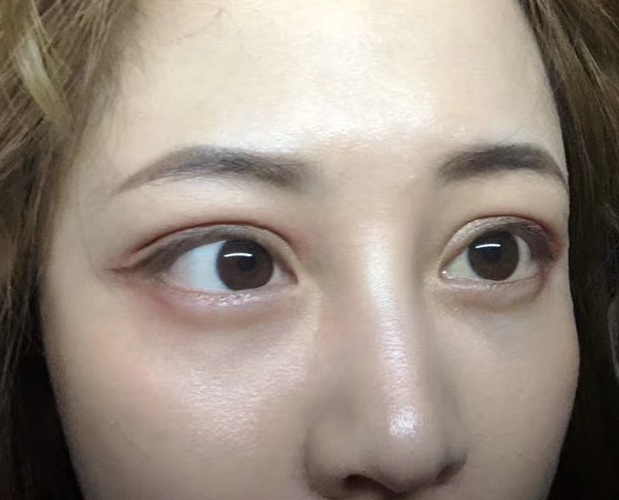 去眼袋手术