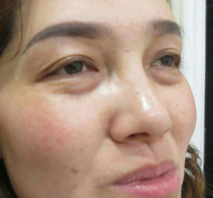 去眼袋手术