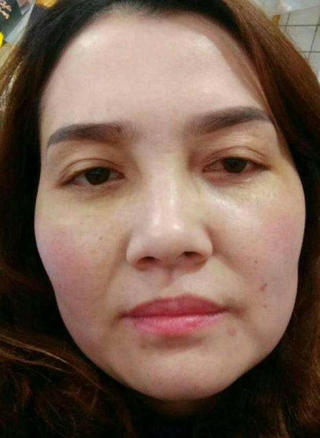 去眼袋手术
