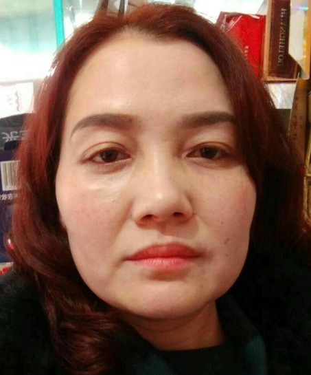 去眼袋手术