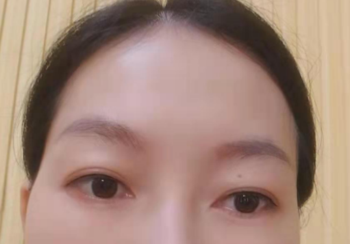 去眼袋手术