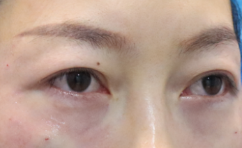去眼袋手术