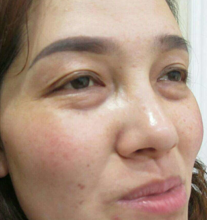 去眼袋手术