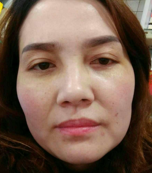 去眼袋手术