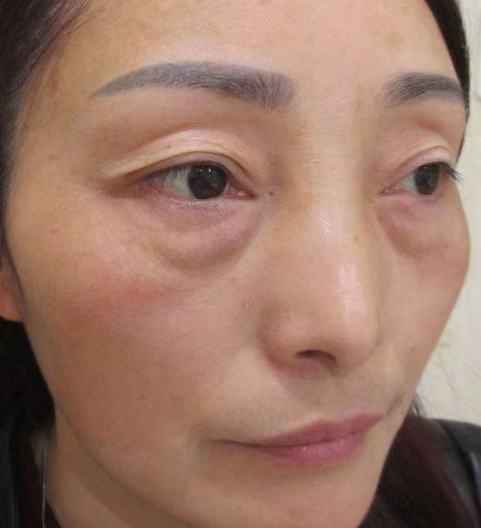 去眼袋手术