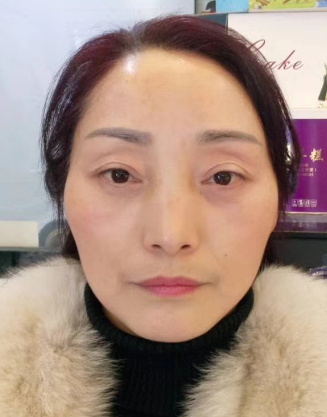 去眼袋手术