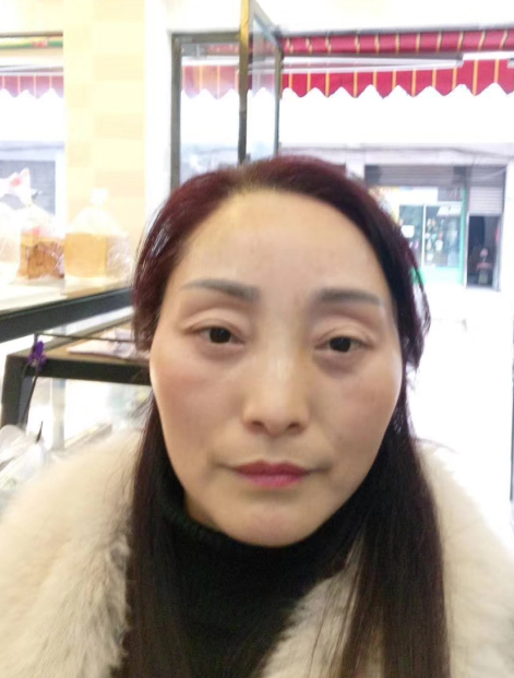 去眼袋手术