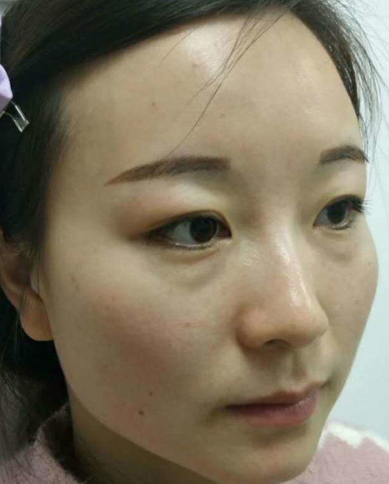 去眼袋手术