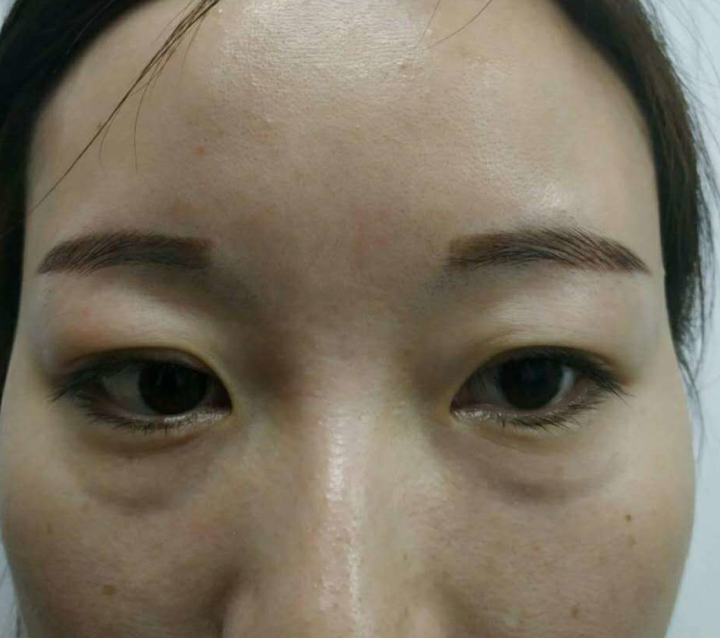 去眼袋手术