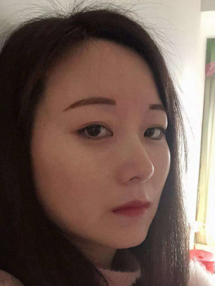 去眼袋手术
