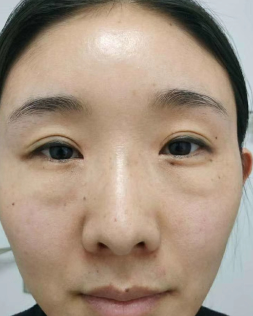 去眼袋手术