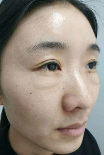 去眼袋手术