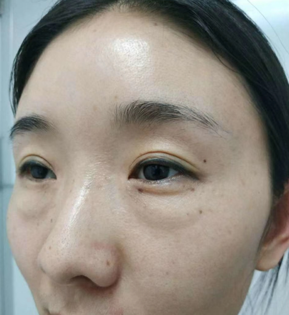 去眼袋手术
