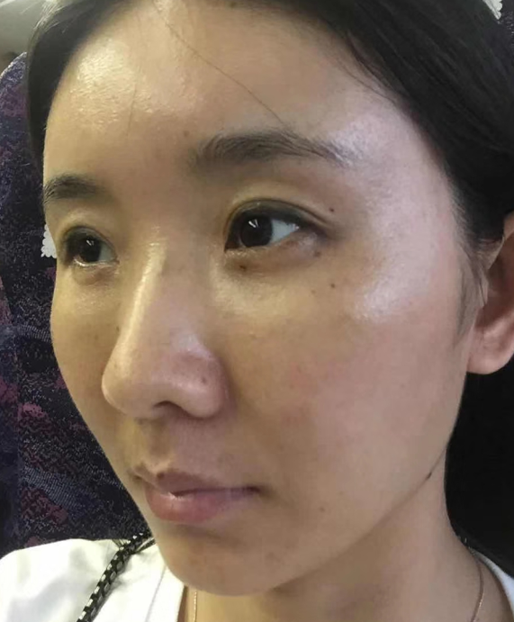 去眼袋手术
