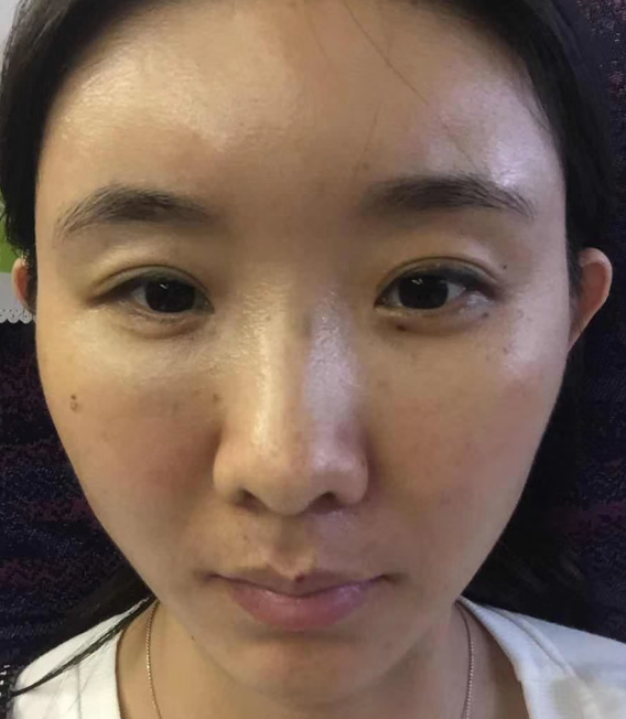 去眼袋手术