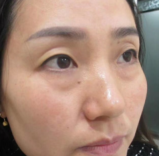 去眼袋手术
