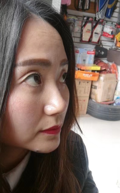 去眼袋手术
