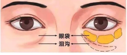 去眼袋手术