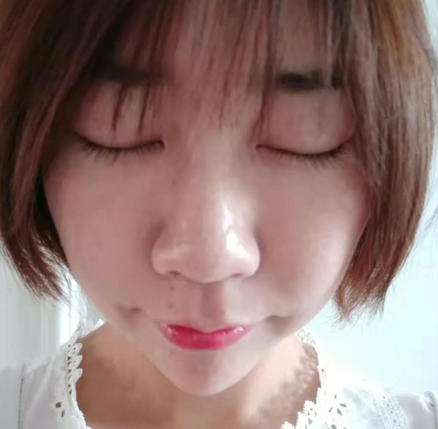 去眼袋手术