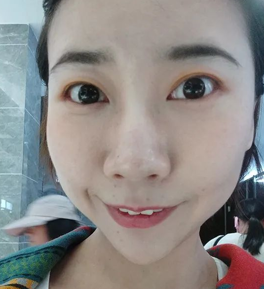 去眼袋手术