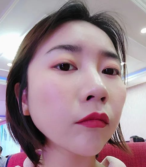去眼袋手术