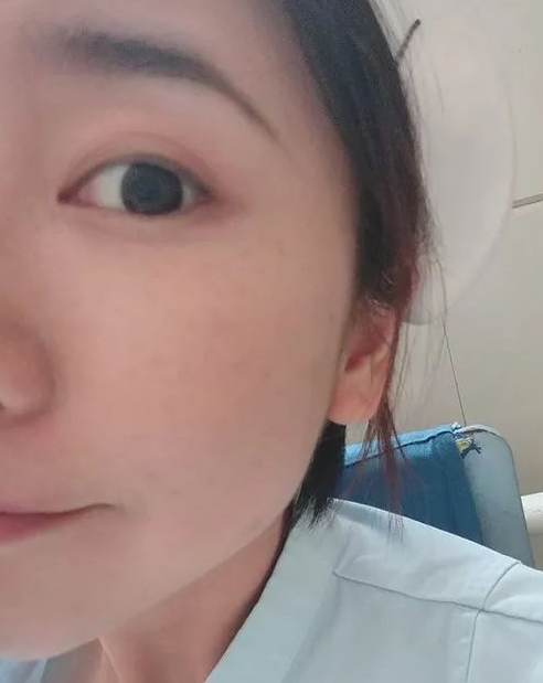 去眼袋手术