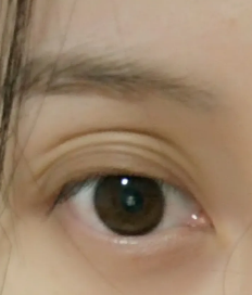 双眼皮手术