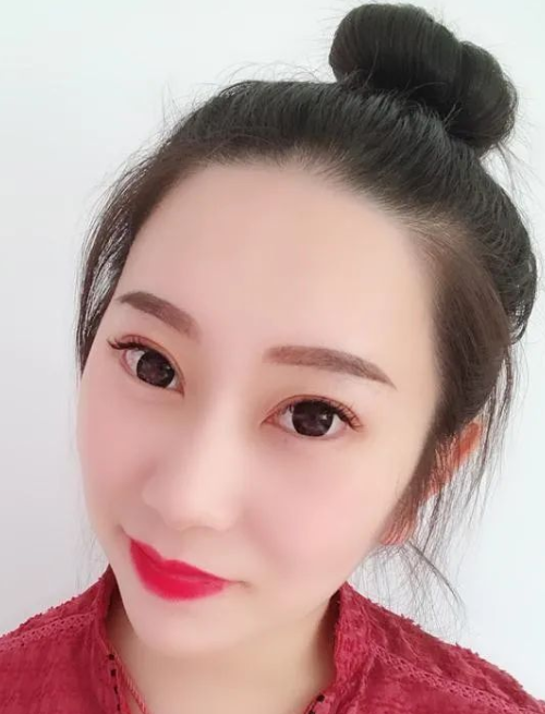 双眼皮手术