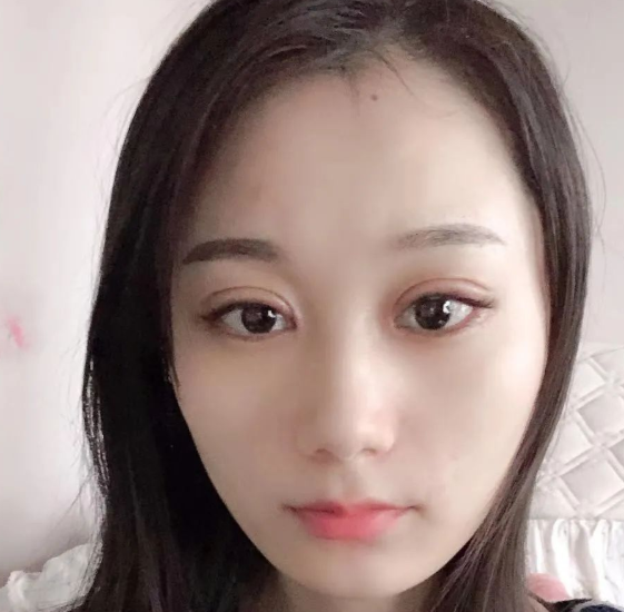 双眼皮手术