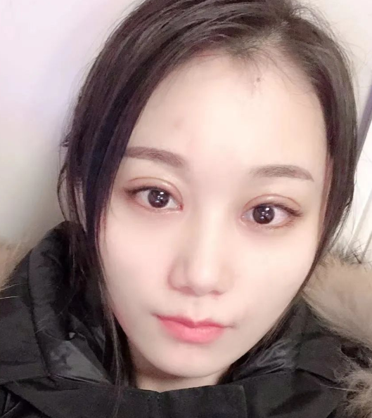 双眼皮手术