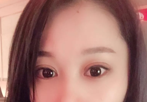 双眼皮手术