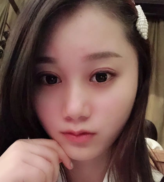 双眼皮手术