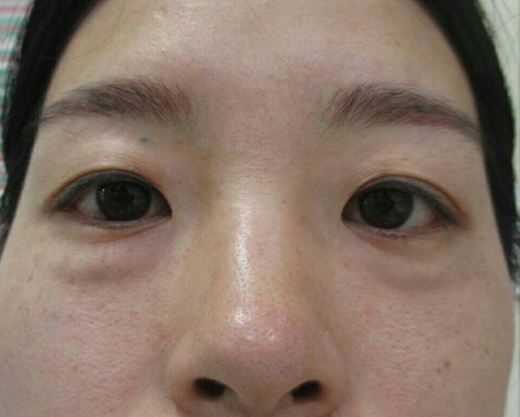 去眼袋手术