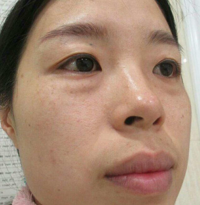 去眼袋手术