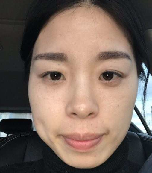 去眼袋手术