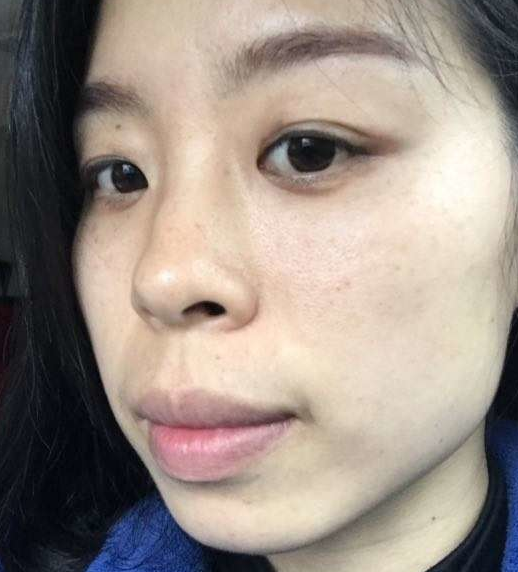去眼袋手术