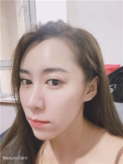 去眼袋手术