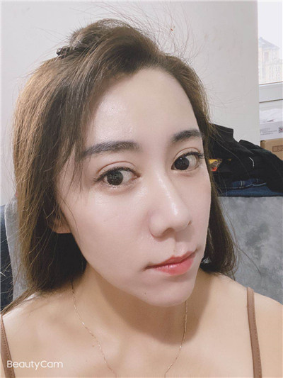 去眼袋手术