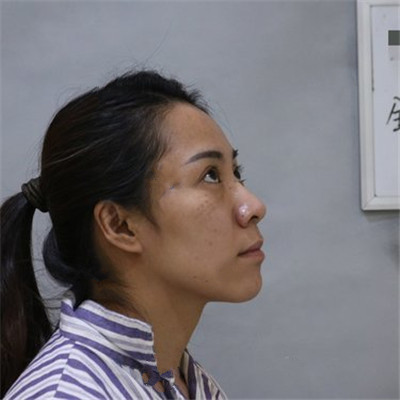 去眼袋手术