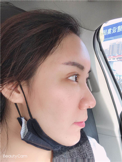 去眼袋手术
