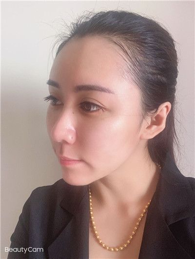 去眼袋手术
