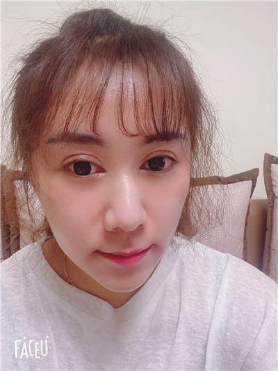 去眼袋手术