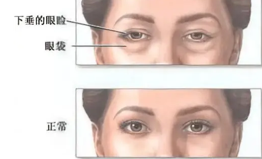 去眼袋手术